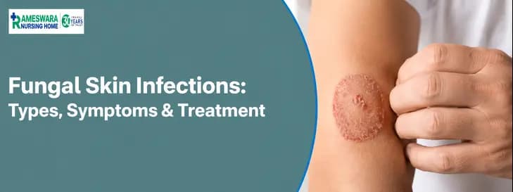 Fungal Skin Infections 1